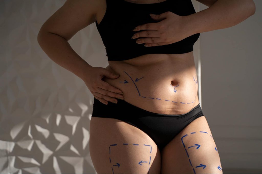 Abdominoplasty (Tummy Tuck): Rebuilding Confidence and Core Strength
