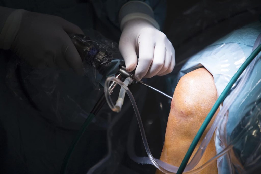 Arthroscopic Knee Surgery: What to Expect